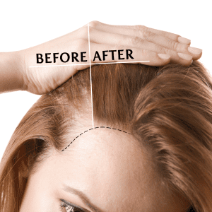 Before and after images of hair loss treatment