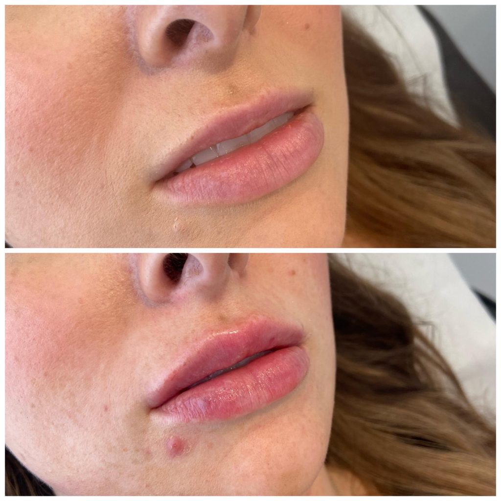 Lip Fillers - Before & After