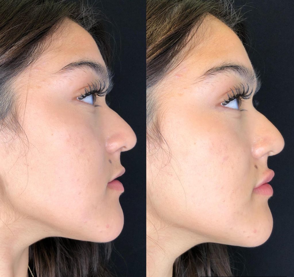 Lip fillers near me prices