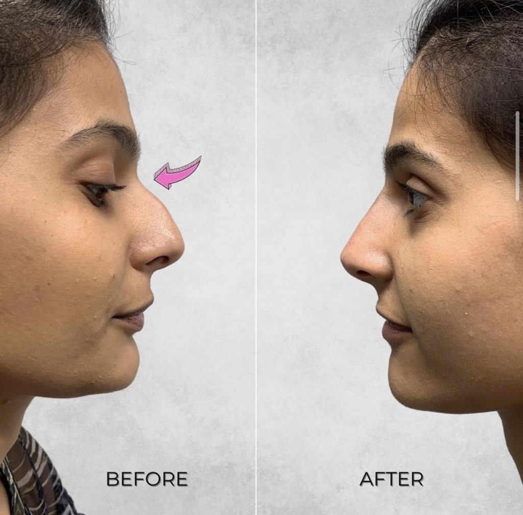 Before and after image of a woman who had the non surgical nose job treatment at Omniya