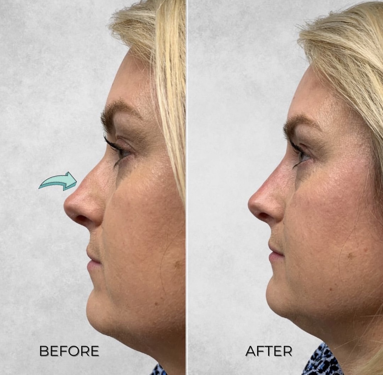 Before and after side profile of a woman after non surgical nose job treatment