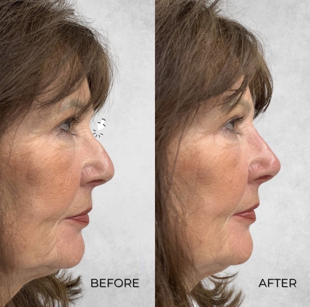 Non surgical nose job before and after side profile of a clients face