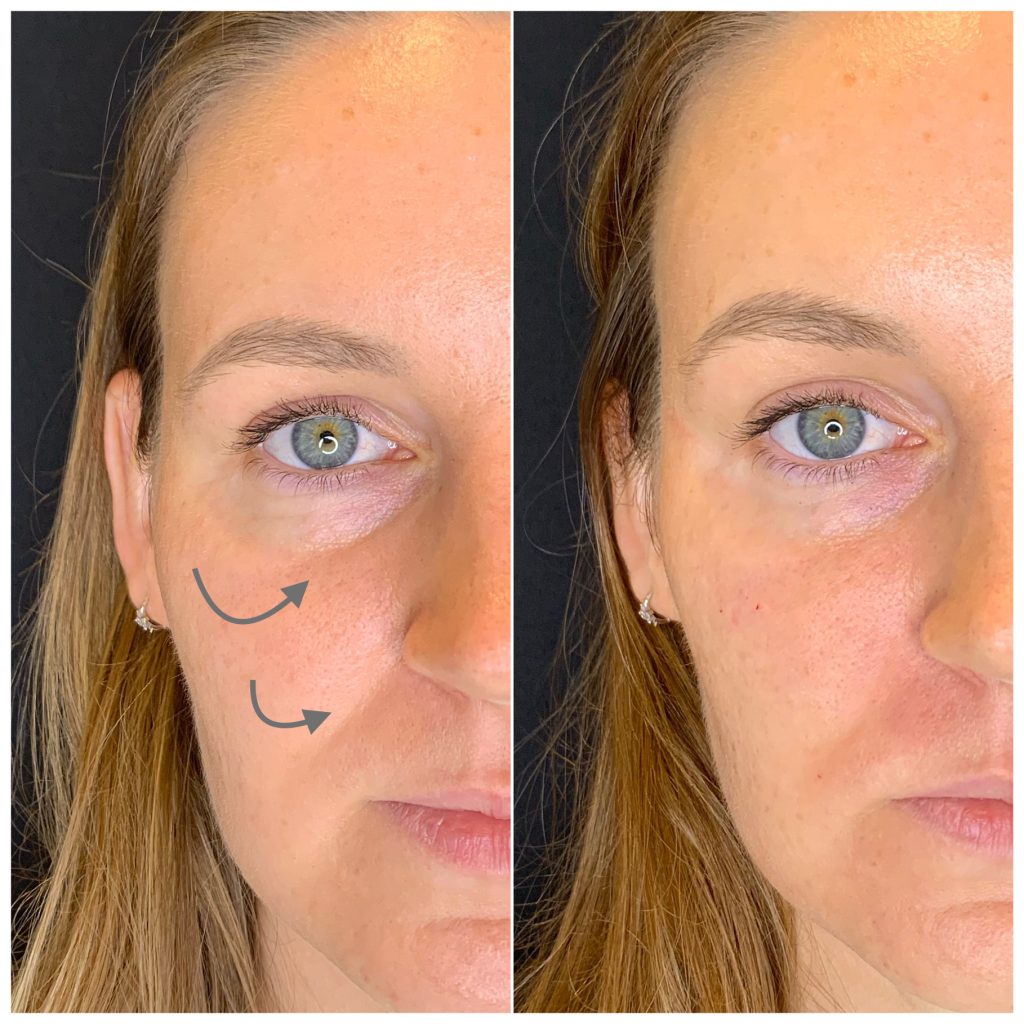 An image of before and after of tear through fillers with arrows showing the changes