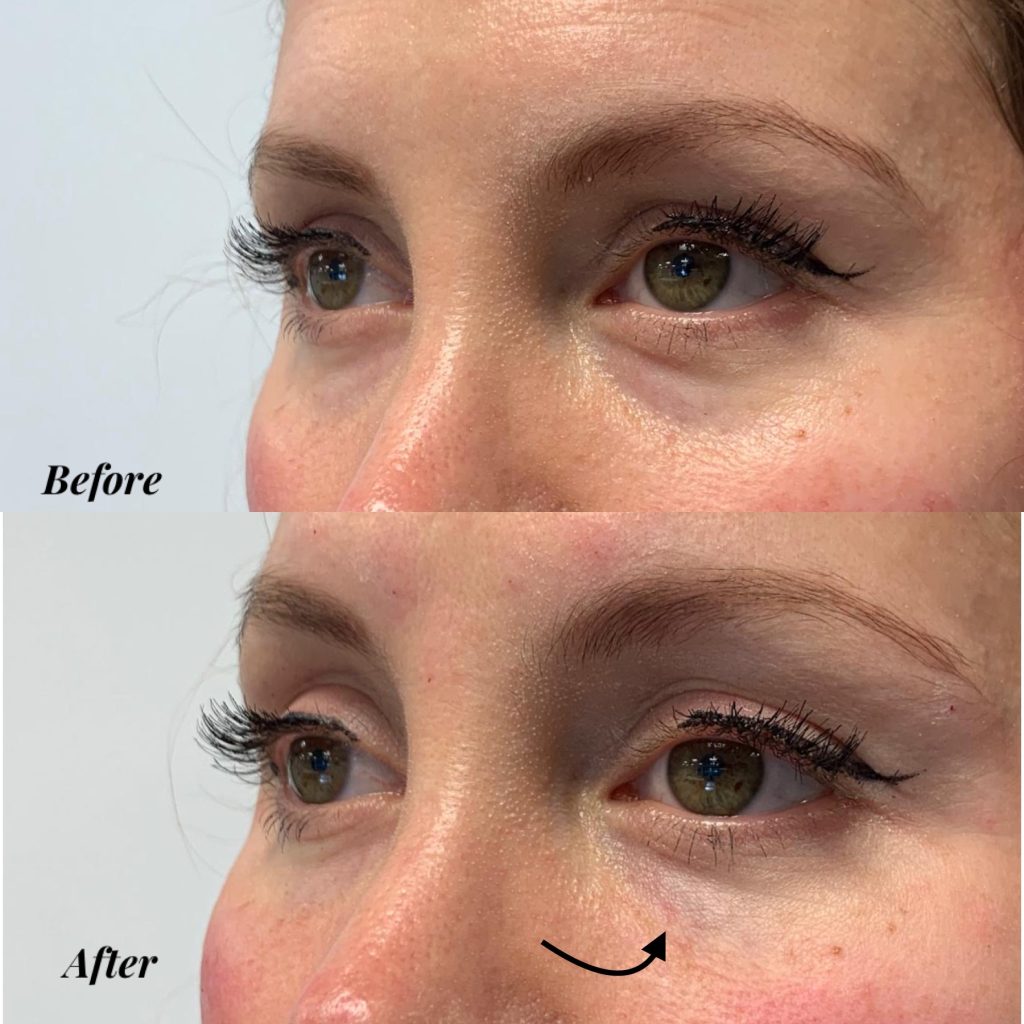 An image of the before and after fo a patient who had the tear through fillers