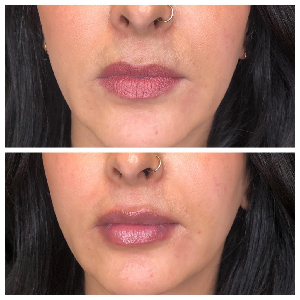 Best Natural Lip Fillers, Lip injections & Lip augmentation in London