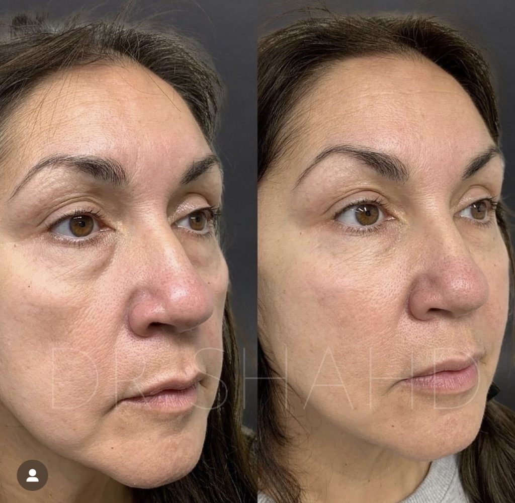 A side by side comparison of the before and after of a tear through filler treatment