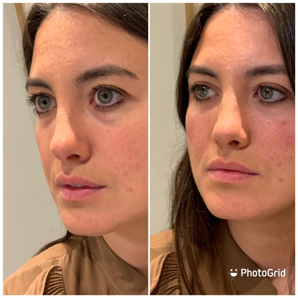 Before and after image of tear through treatment